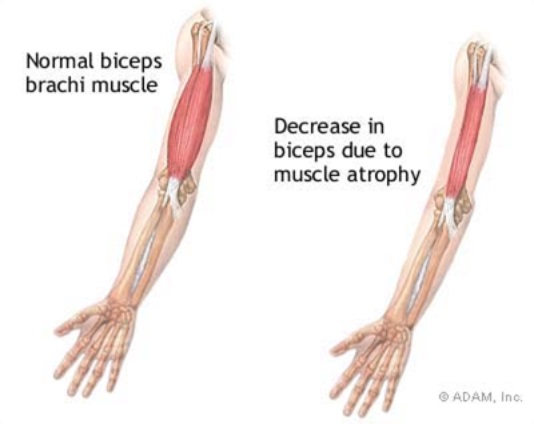 Otot lengan atas mengecil karena jarang dipakai