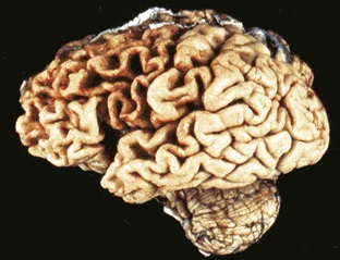 Bagian otak yang berwarna lebih gelap mengalami atrofi