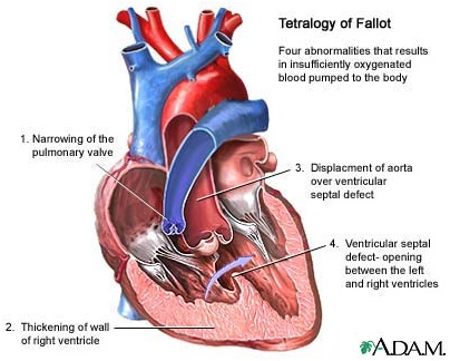 Tetralogy of Fallot, keadaan ketika jantung mengalami empat keabnormalan yang menyebabkan kurangnya jumlah darah kaya oksigen yang dipompa ke seluruh tubuh.