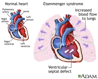 Perbandingan antara jantung sehat dan jantung dengan sindroma Eisenmenger.