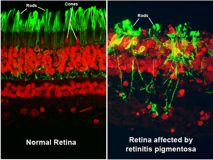 Perbandingan retina normal (kiri) dan retina yang rusak karena retinitis pigmentosa (kanan). Sumber: http://www.visionaware.org/info/your-eye-condition/retinitis-pigmentosa/12