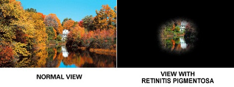 Pemandangan yang dilihat oleh orang dengan mata normal (kiri) dan penderita retinitis pigmentosa (kanan). Sumber: http://www.eyehealthweb.com/retinitis-pigmentosa/