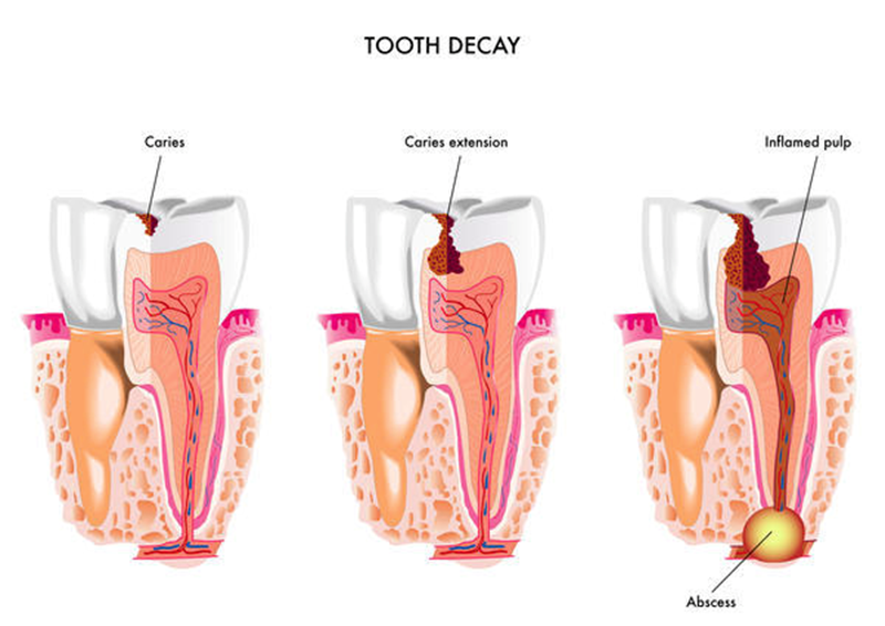 Proses infeksi pada gigi. Sumber gambar: http://thedentistshornsby.com.au