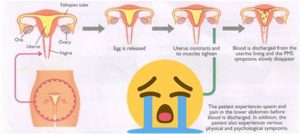 Diagram menstruasi hingga terjadinya dysmenorrhea. Sumber gambar: mygynae.co.uk